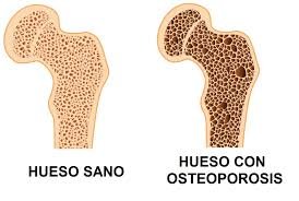 Imagen que muestra la comparación de un hueso sano con el de un hueso con osteoporosis