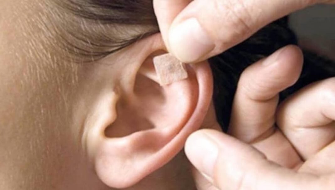 Auriculoterapia