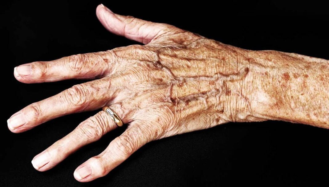 Cuida la piel de los adultos mayores, ellos requieren cuidados especiales