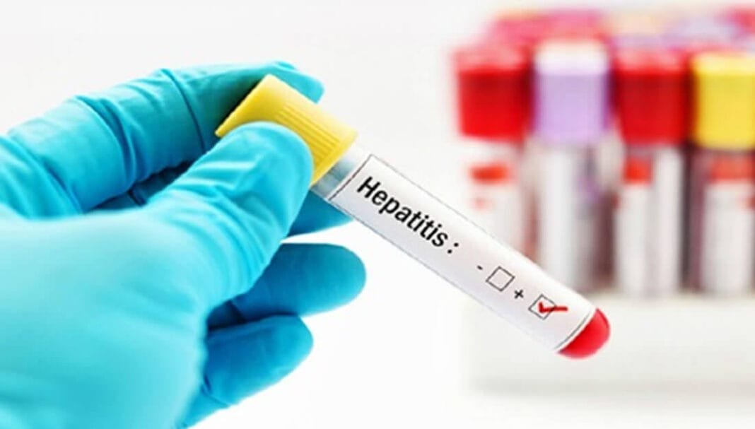 Revelan datos claves para entender la hepatitis A