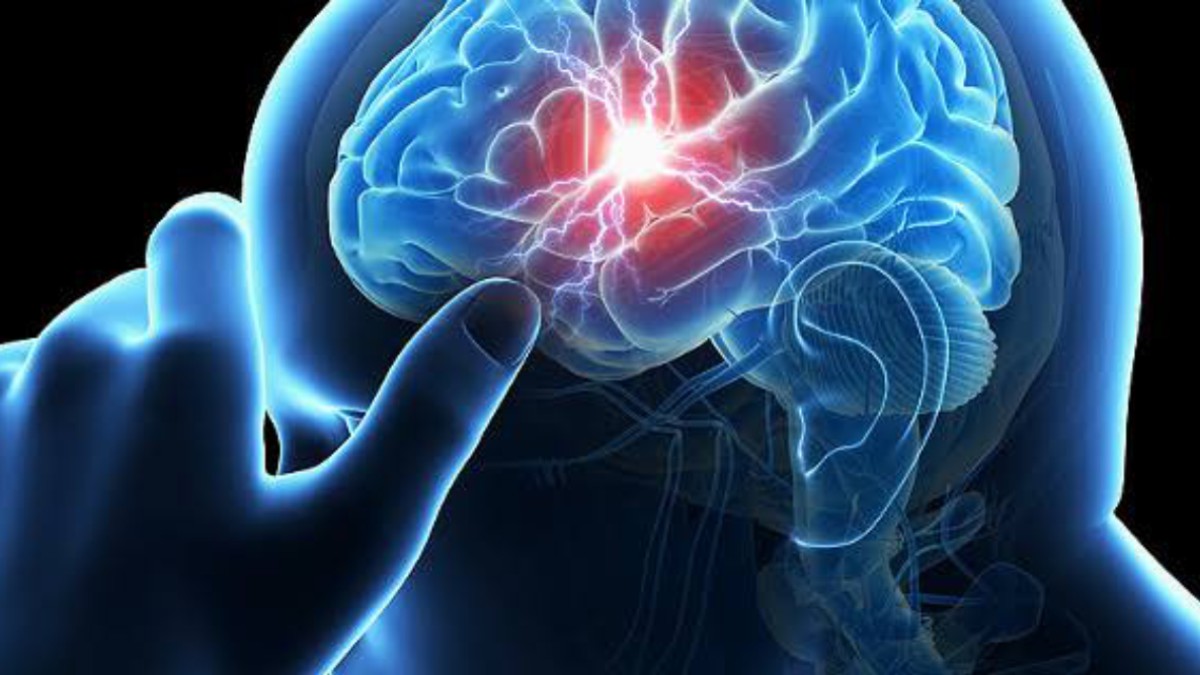 Alertan por aumento de casos infarto cerebral Alertan por aumento de casos infarto cerebral