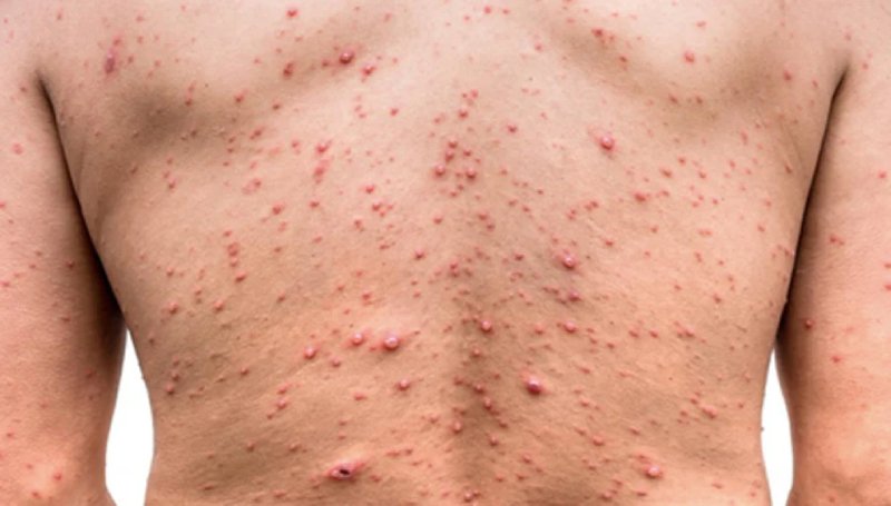 Viruela del Mono en Puerto Vallarta