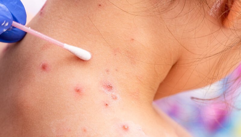 La OMS informó que existen más de 6,000 casos de Viruela del Mono