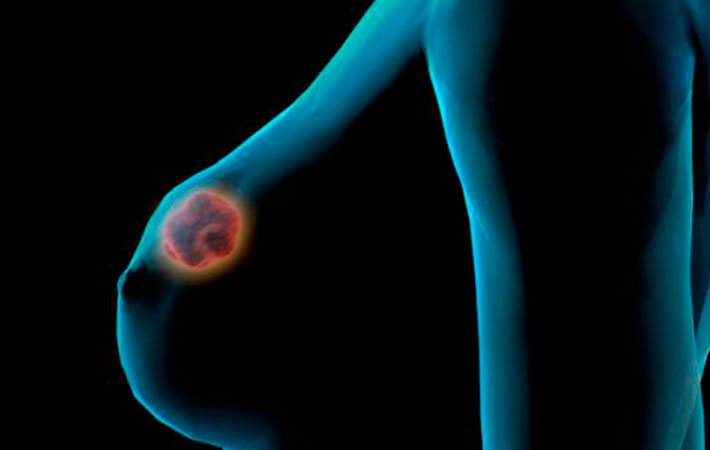 Cáncer de mama triple negativo afecta a mujeres jóvenes y es más agresivo