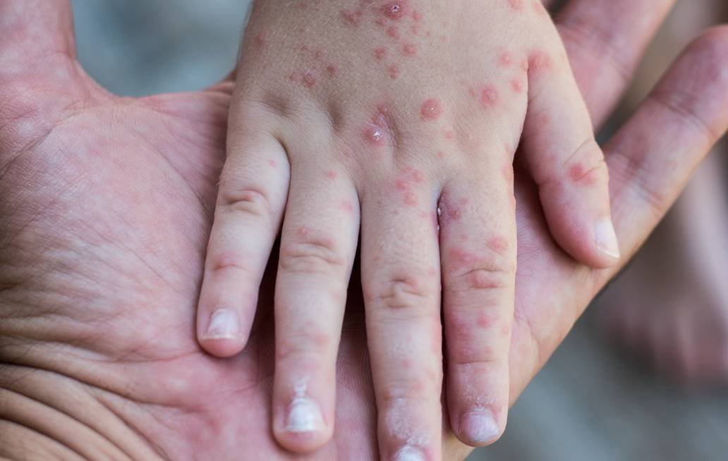 Atienden brote de virus coxsackie en escuela de Bosques de San Sebastián en Ciudad de Puebla