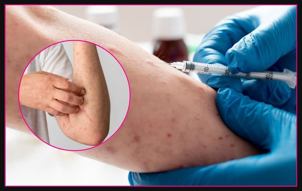 Puebla confirma primer caso de sarampión en 2026