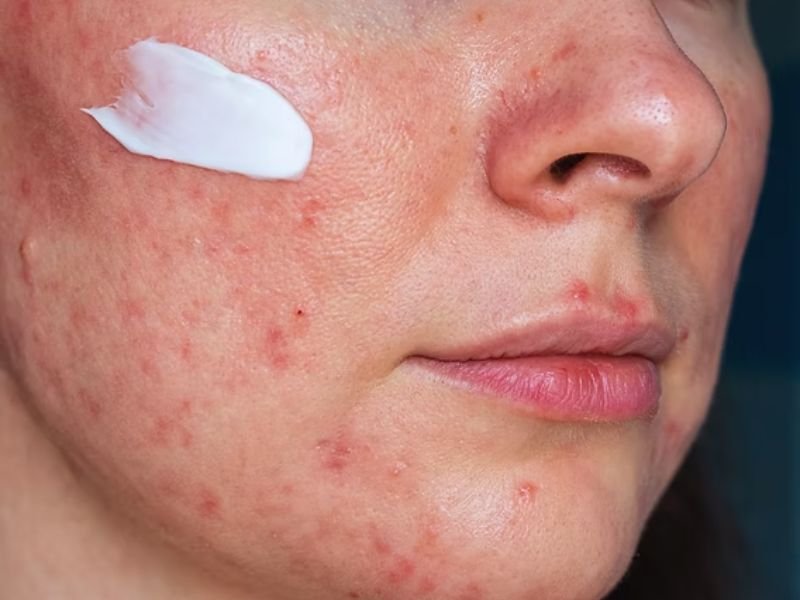 rosácea