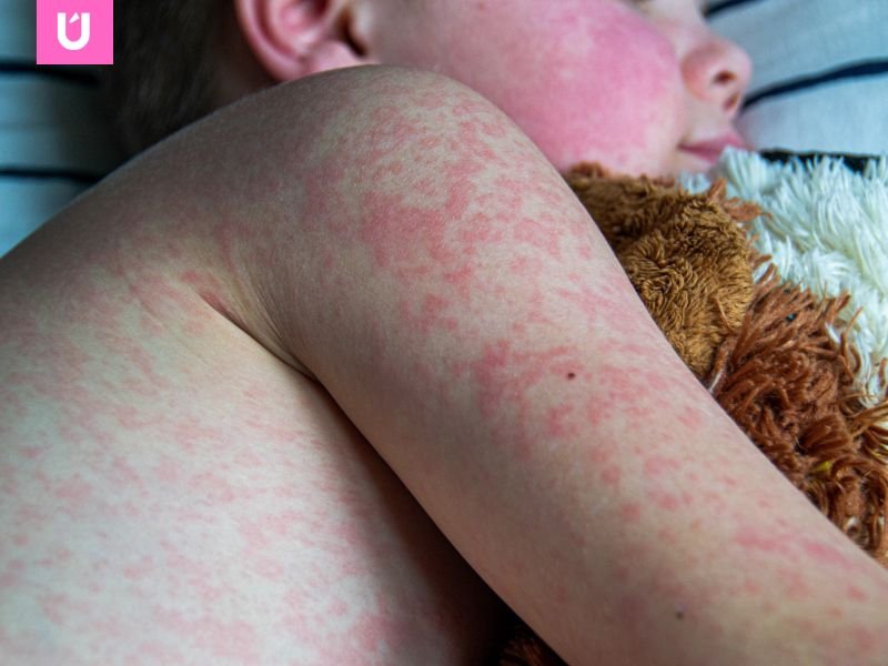 sarampion en méxico